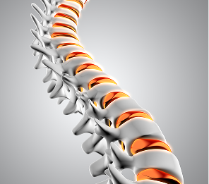 Scoliosis