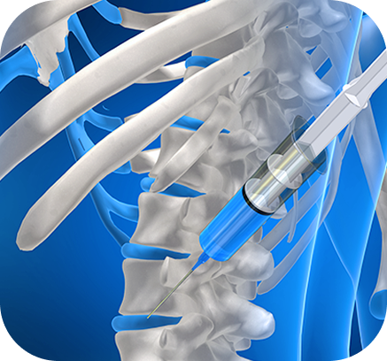 nerve block